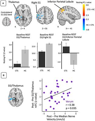 S1 Brain Connectivity in Carpal Tunnel Syndrome Underlies Median Nerve and Functional Improvement Following Electro-Acupuncture